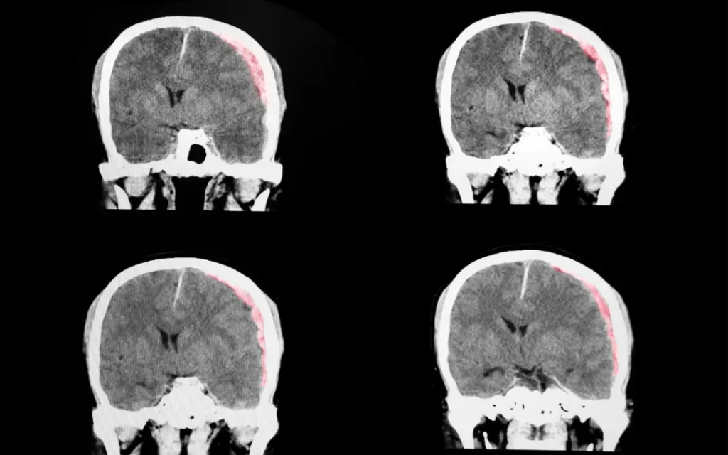 Traumatic-Brain-Injuries-and-Legal-Action-in-Georgia