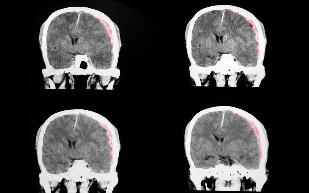 Traumatic-Brain-Injuries-and-Legal-Action-in-Georgia